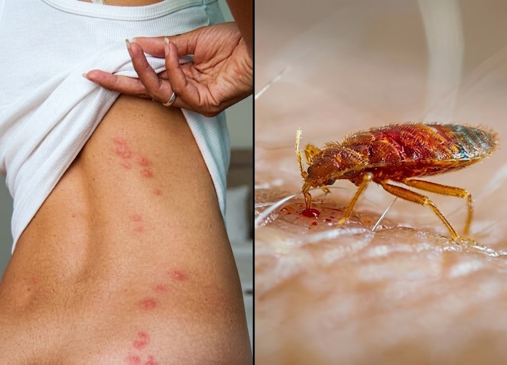 Ronchas alineadas de picaduras de chinche en el costado del torso, junto a un primer plano de una chinche alimentándose sobre la piel